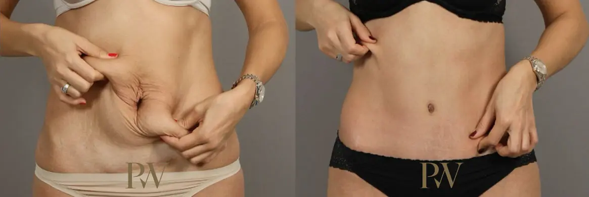Paul Wilson - Abdominoplasty - Tummy Tuck Patient Image 7