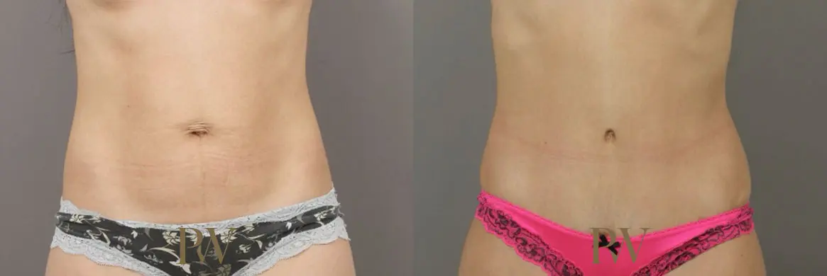 Paul Wilson - Abdominoplasty - Tummy Tuck Patient Image 9