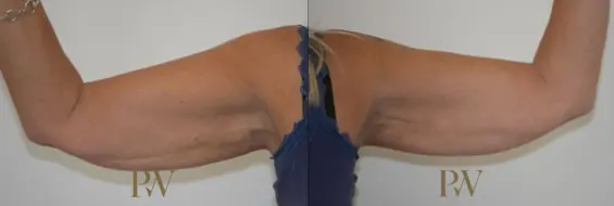 Paul Wilson - Arm Lift Patient Image 1