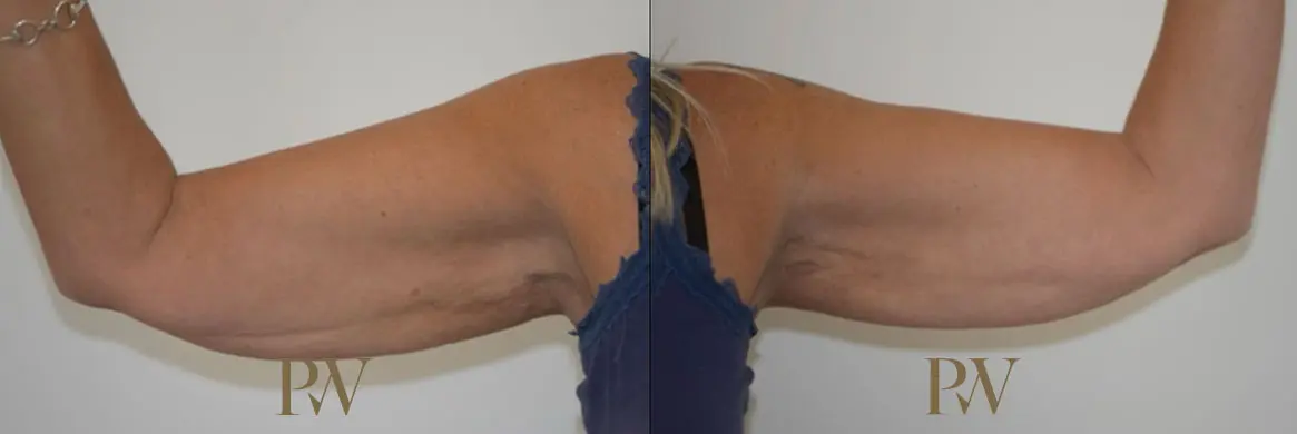 Paul Wilson - Arm Lift Patient Image 1