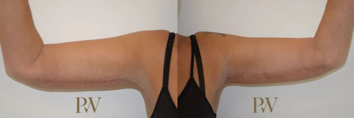 Paul Wilson - Arm Lift Patient Image 2