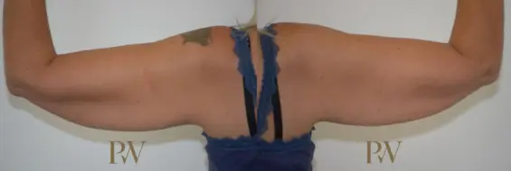 Paul Wilson - Arm Lift Patient Image 3