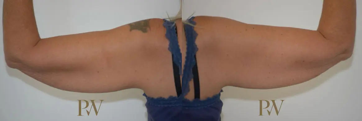 Paul Wilson - Arm Lift Patient Image 3