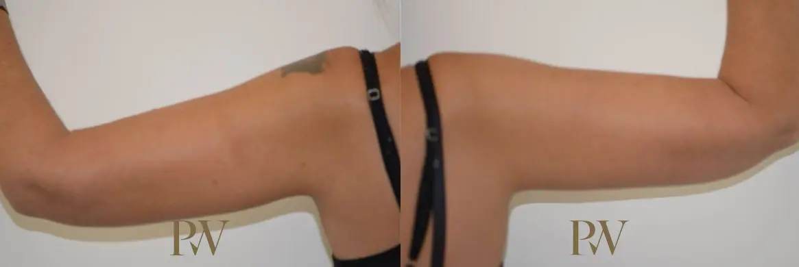 Paul Wilson - Arm Lift Patient Image 4