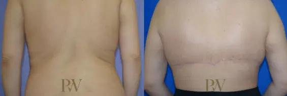 Paul Wilson - Bra Line Back Lift Patient Image 1
