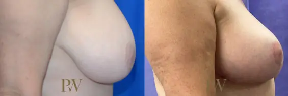 Paul Wilson - Breast Reduction Surgery Patient Image 1