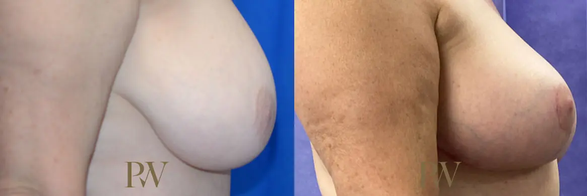 Paul Wilson - Breast Reduction Surgery Patient Image 1