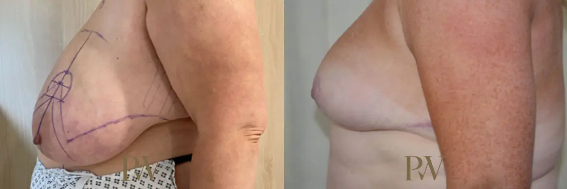 Paul Wilson - Breast Reduction Surgery Patient Image 11