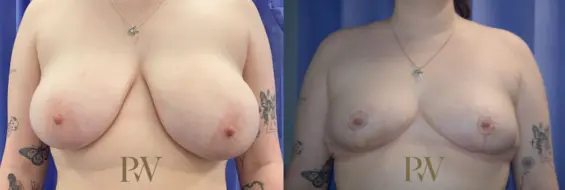 Paul Wilson - Breast Reduction Surgery Patient Image 15