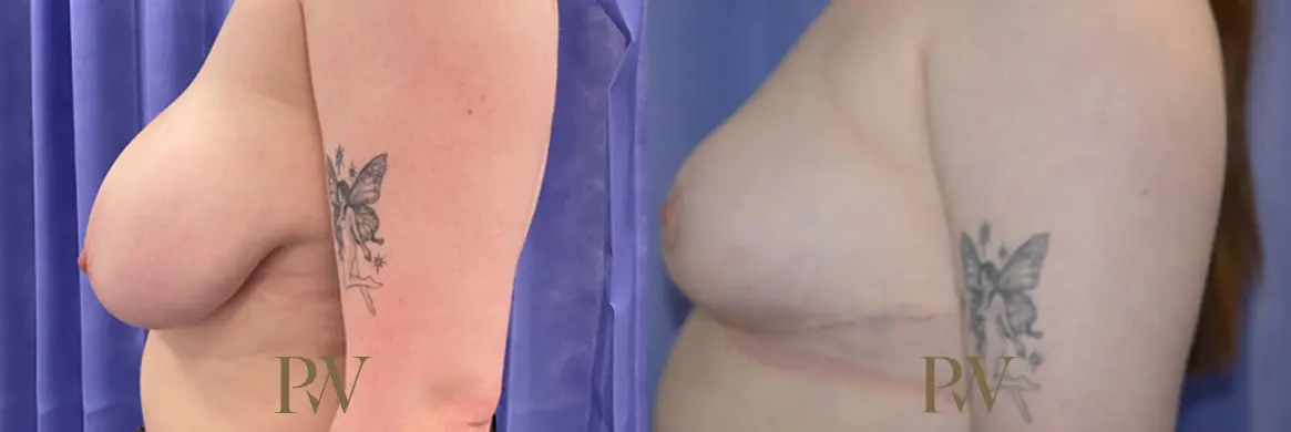 Paul Wilson - Breast Reduction Surgery Patient Image 16