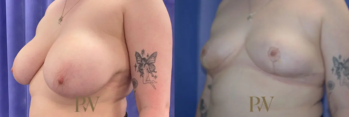Paul Wilson - Breast Reduction Surgery Patient Image 17