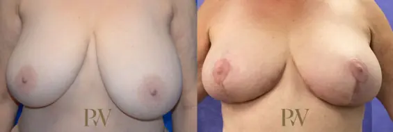 Paul Wilson - Breast Reduction Surgery Patient Image 2