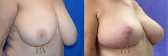 Paul Wilson - Breast Reduction Surgery Patient Image 3
