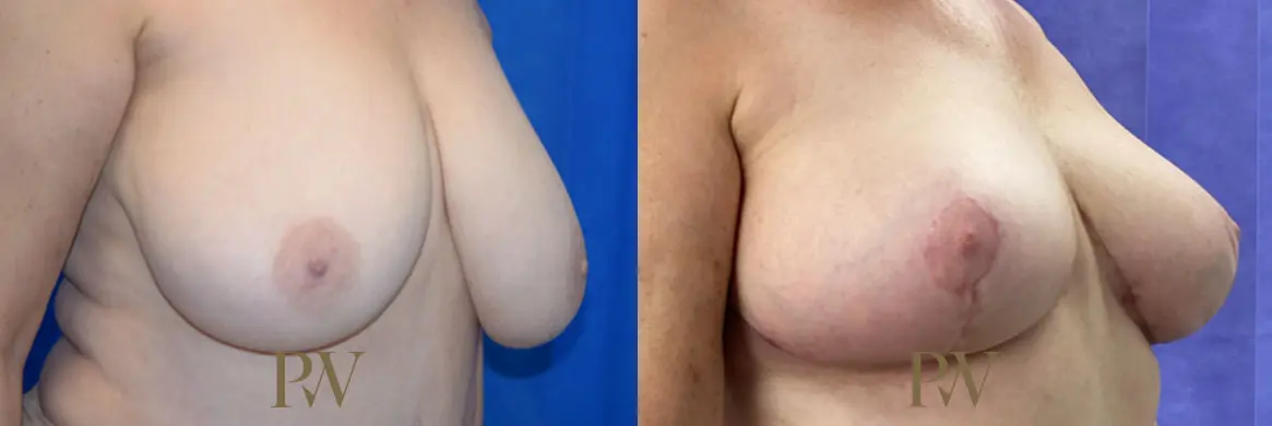 Paul Wilson - Breast Reduction Surgery Patient Image 3