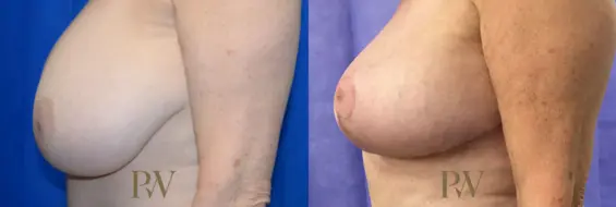 Paul Wilson - Breast Reduction Surgery Patient Image 4