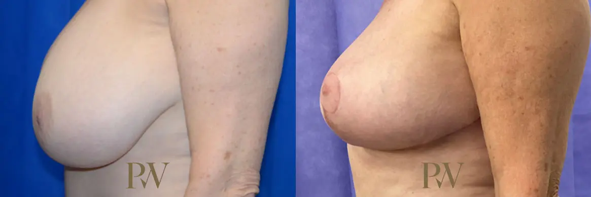 Paul Wilson - Breast Reduction Surgery Patient Image 4