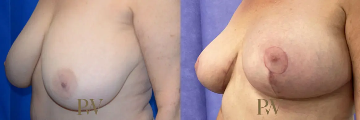 Paul Wilson - Breast Reduction Surgery Patient Image 5