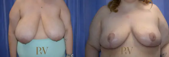 Paul Wilson - Breast Reduction Surgery Patient Image 6