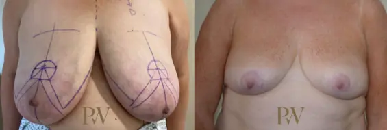 Paul Wilson - Breast Reduction Surgery Patient Image 9