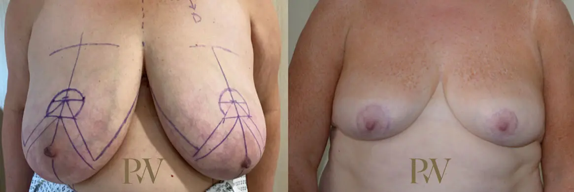 Paul Wilson - Breast Reduction Surgery Patient Image 9