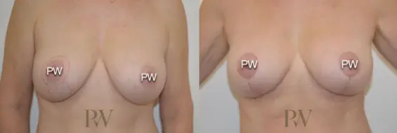 Paul Wilson - Breast Uplift (Mastopexy) Patient Image 1