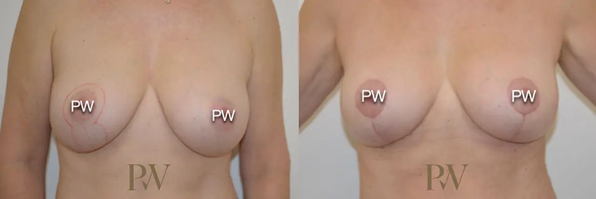 Paul Wilson - Breast Uplift (Mastopexy) Patient Image 1
