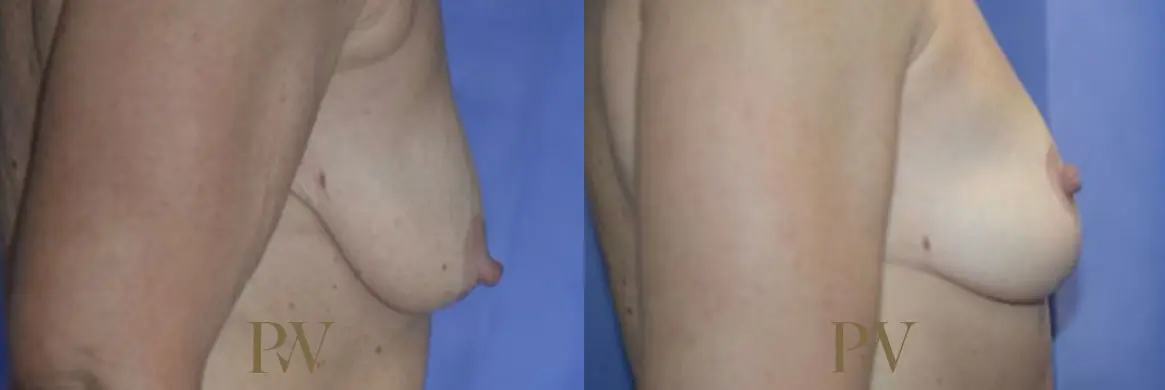 Paul Wilson - Breast Uplift (Mastopexy) Patient Image 10