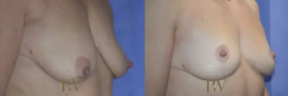 Paul Wilson - Breast Uplift (Mastopexy) Patient Image 11