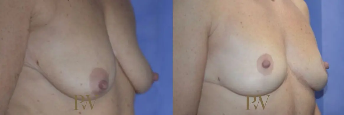 Paul Wilson - Breast Uplift (Mastopexy) Patient Image 11