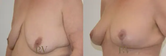 Paul Wilson - Breast Uplift (Mastopexy) Patient Image 14