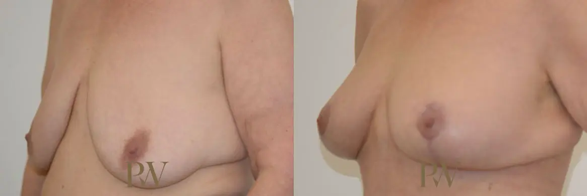 Paul Wilson - Breast Uplift (Mastopexy) Patient Image 14