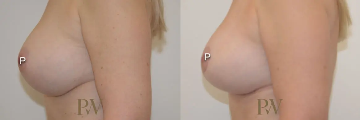 Paul Wilson - Breast Uplift (Mastopexy) Patient Image 2