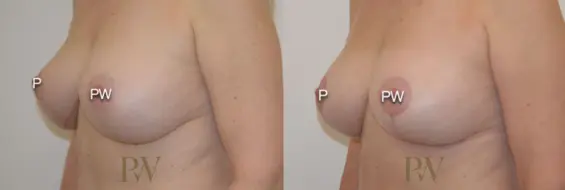 Paul Wilson - Breast Uplift (Mastopexy) Patient Image 3