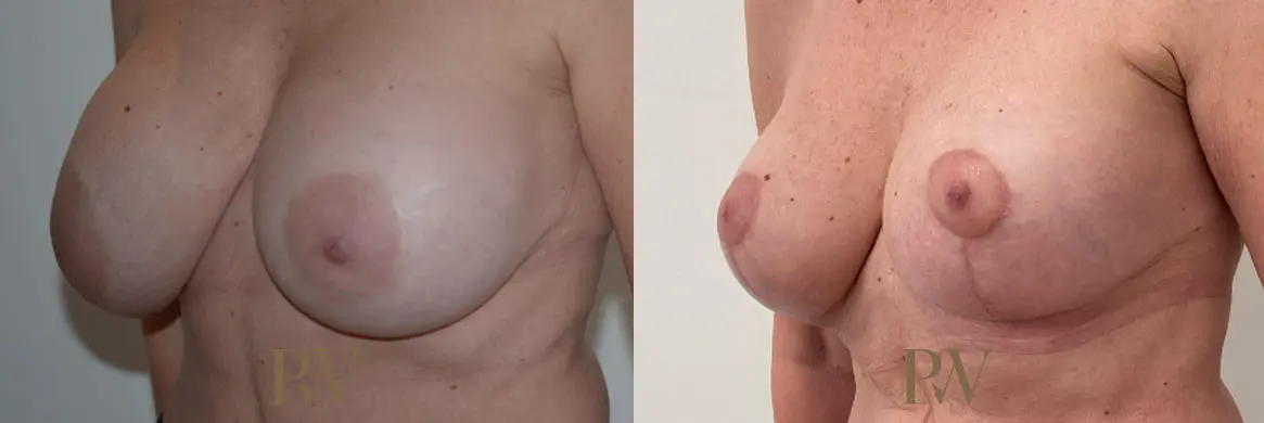 Paul Wilson - Breast Uplift (Mastopexy) Patient Image 6