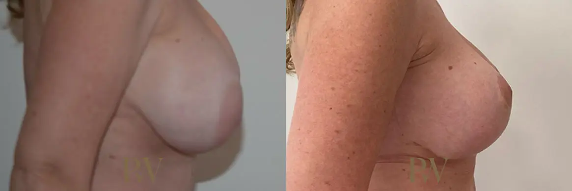 Paul Wilson - Breast Uplift (Mastopexy) Patient Image 7