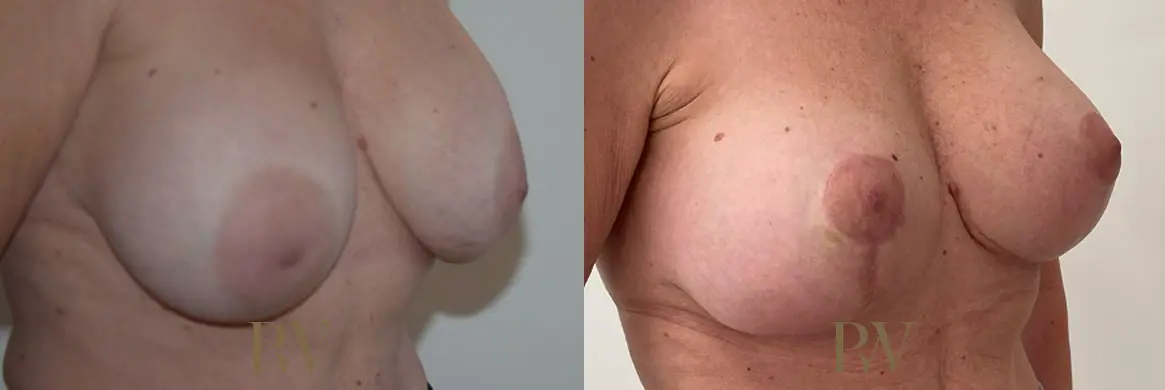 Paul Wilson - Breast Uplift (Mastopexy) Patient Image 8