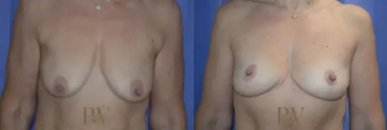 Paul Wilson - Breast Uplift (Mastopexy) Patient Image 9