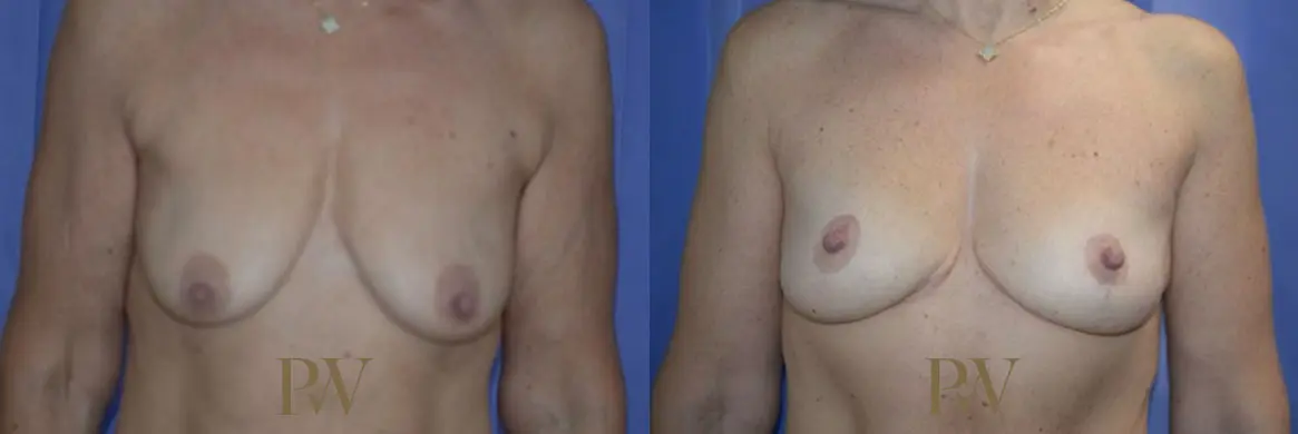 Paul Wilson - Breast Uplift (Mastopexy) Patient Image 9