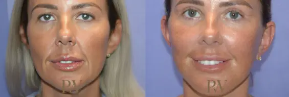 Paul Wilson - Deep Plane Facelift Patient Image 1