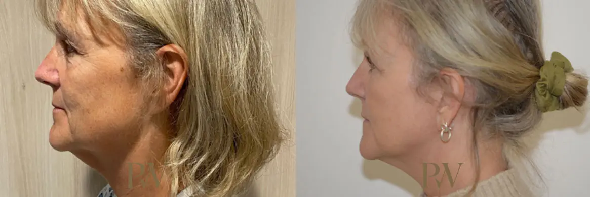 Paul Wilson - Deep Plane Facelift Patient Image 10