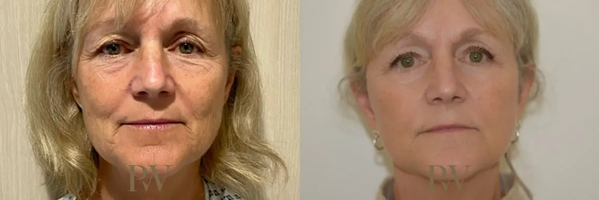 Paul Wilson - Deep Plane Facelift Patient Image 11