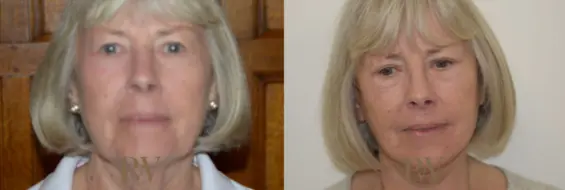 Paul Wilson - Deep Plane Facelift Patient Image 12