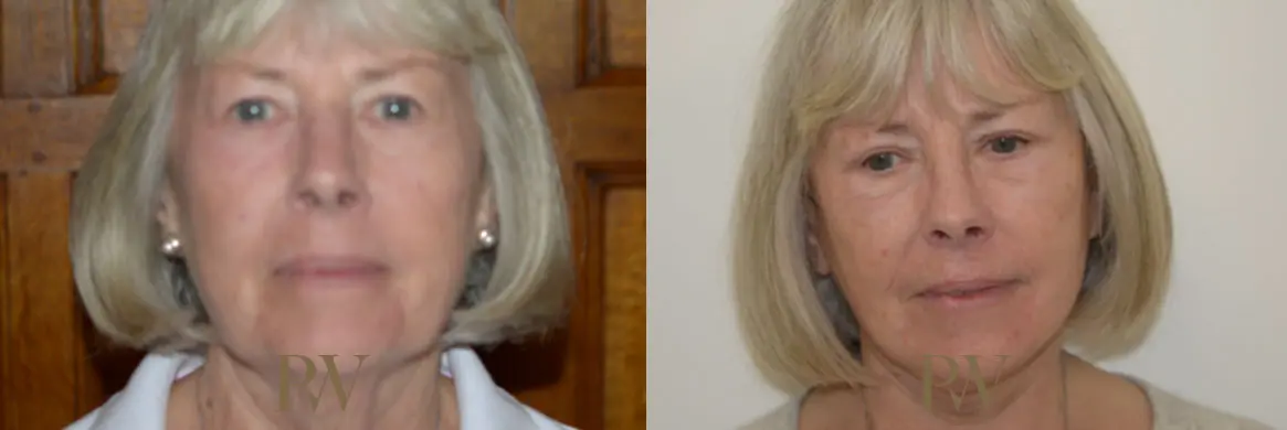 Paul Wilson - Deep Plane Facelift Patient Image 12