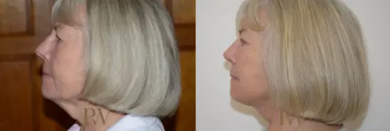 Paul Wilson - Deep Plane Facelift Patient Image 13