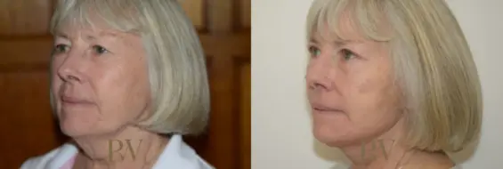 Paul Wilson - Deep Plane Facelift Patient Image 14