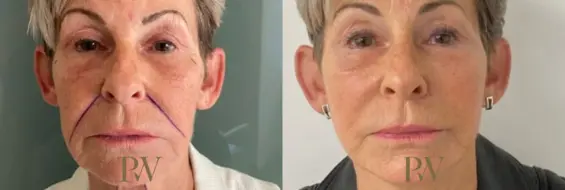 Paul Wilson - Deep Plane Facelift Patient Image 15