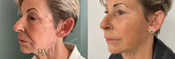 Paul Wilson - Deep Plane Facelift Patient Image 16