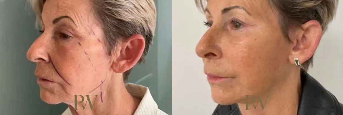 Paul Wilson - Deep Plane Facelift Patient Image 16