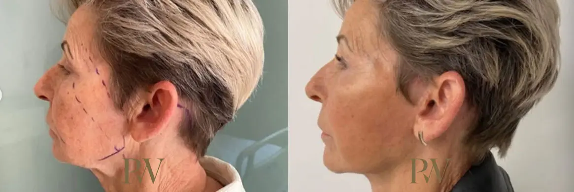 Paul Wilson - Deep Plane Facelift Patient Image 17