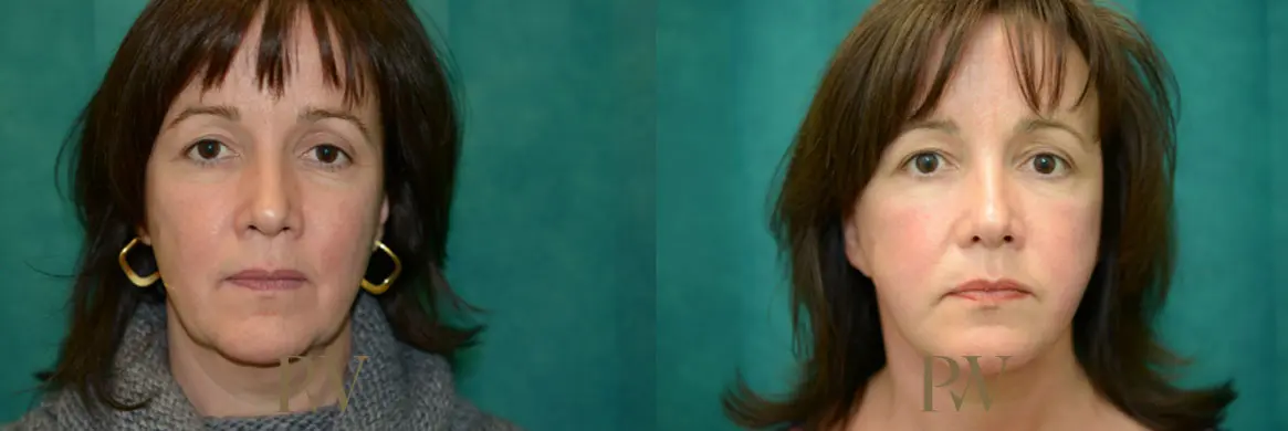 Paul Wilson - Deep Plane Facelift Patient Image 19